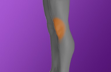 Anterior_Knee_Patella_Femoral_pain.jpg