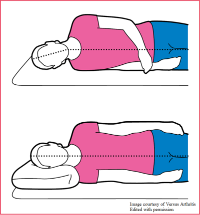 Split image with a person lying on their side without a pillow causing the head to drop down towards the bed. Another person is lying on their side with a pillow so their head is in line with their body