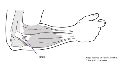 Tennis_elbow_location.jpg