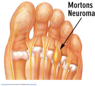 Mortons_Neuroma.png