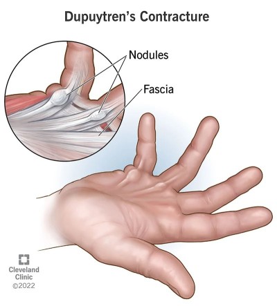 dupuytrens contracture.jpg