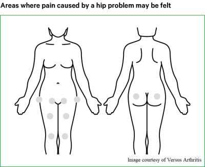 Hip Pain Affected Areas.png